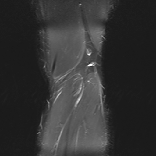 File:Anterior cruciate ligament full thickness tear (Radiopaedia 66268-75467 Coronal STIR 22).jpg