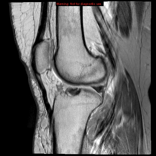 File:Anterior cruciate ligament tear (Radiopaedia 12329-12612 Sagittal T2 fat sat 9).jpg