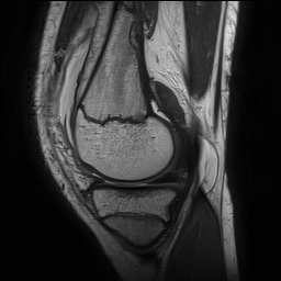 File:Anterior cruciate ligament tear - pediatric (Radiopaedia 62152-70260 Sagittal PD 57).jpg