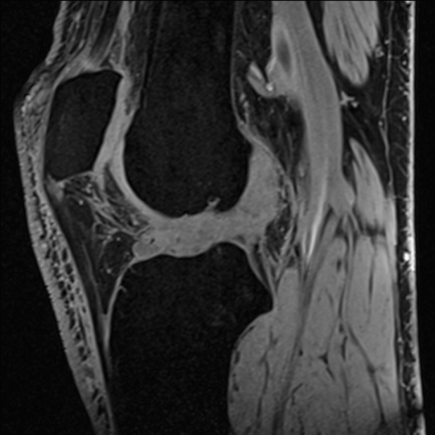 Anterior cruciate ligament tear - ramp lesion (Radiopaedia 71883-82322 Sagittal T1 vibe 67).jpg