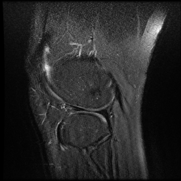 File:Anterior cruciate ligament tear with posteromedial corner injury, bucket-handle meniscal tear and chondral delamination (Radiopaedia 75501-86744 Sagittal PD fat sat 23).jpg