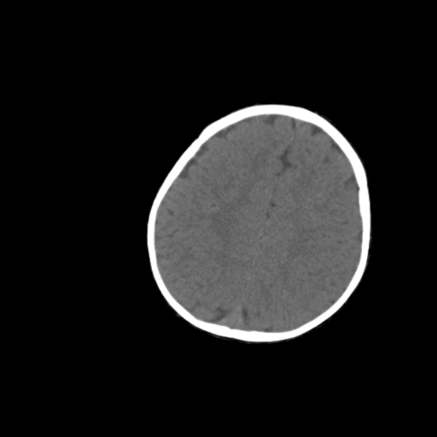 Anterior fontanelle inclusion cyst (Radiopaedia 62003-70087 Axial non-contrast 61).jpg