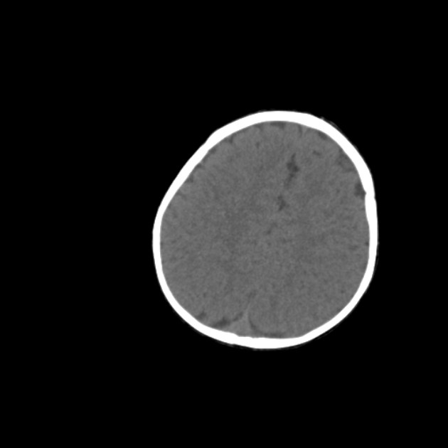 Anterior fontanelle inclusion cyst (Radiopaedia 62003-70087 Axial non-contrast 62).jpg