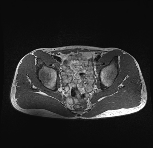 File:Anterior inferior iliac spine avulsion fracture (Radiopaedia 81312-95000 Axial T1 22).jpg