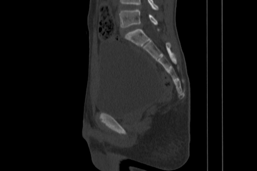 Anterior inferior iliac spine avulsion injury (Radiopaedia 88666-105376 Sagittal bone window 50).jpg