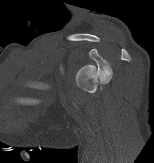 Anterior shoulder dislocation with Hill-Sachs and bony Bankart lesions (Radiopaedia 40424-42974 Sagittal bone window 27).png