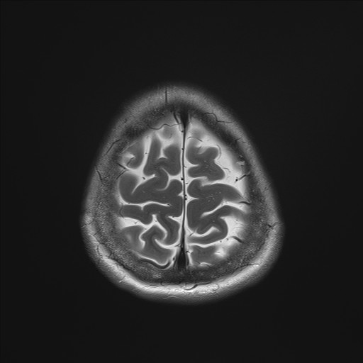 File:Anterior temporal encephalocele (Radiopaedia 82624-96808 Axial T2 35).jpg
