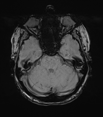 Anterior temporal lobe perivascular space (Radiopaedia 40946-43650 Axial SWI 25).png