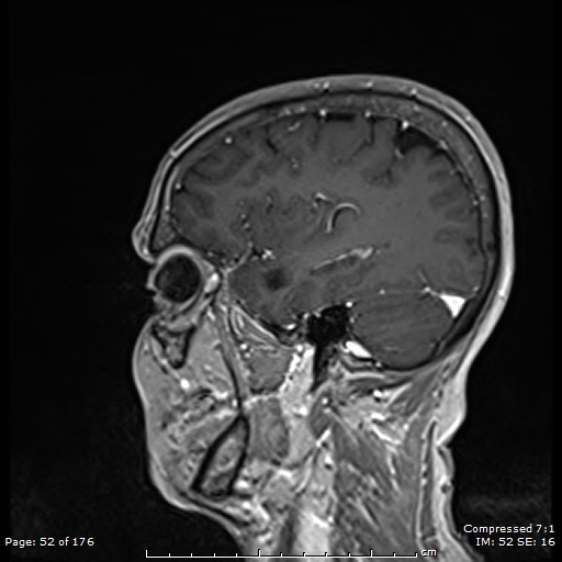 File:Anterior temporal lobe perivascular space (Radiopaedia 88283-104914 Sagittal T1 C+ 13).jpg