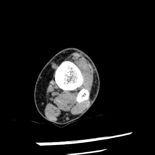 File:Anterior tibial artery false aneurysm (Radiopaedia 88984-105809 A 66).jpg