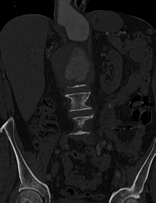 File:Anterior vertebral scalloping (abdominal aortic aneurysm) (Radiopaedia 66744-76067 Coronal bone window 23).jpg
