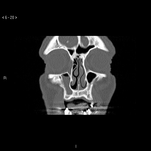 File:Antrochoanal Polyp (Radiopaedia 70510-80631 Coronal bone window 9).jpg