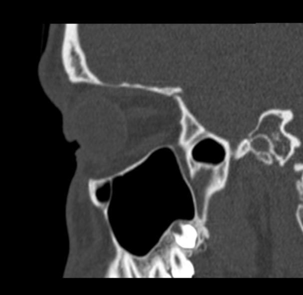 Antrochoanal polyp (Radiopaedia 33984-35202 Sagittal bone window 62).jpg
