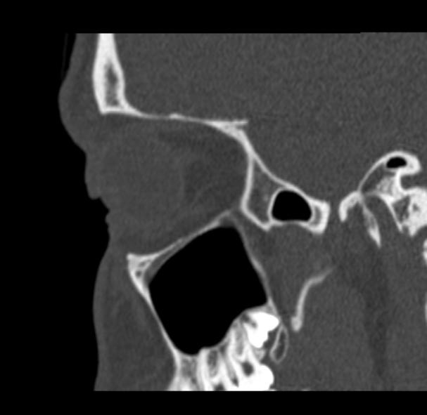 Antrochoanal polyp (Radiopaedia 33984-35202 Sagittal bone window 65).jpg