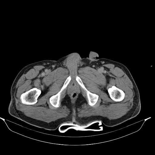 File:Aortic dissection- Stanford type A (Radiopaedia 22085-22085 Axial C+ delayed 57).jpg