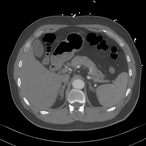 Aortic dissection (Radiopaedia 50763-56234 A 80).png