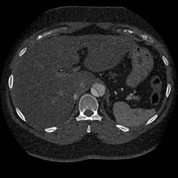Aortic dissection (Radiopaedia 57969-64959 A 307).jpg