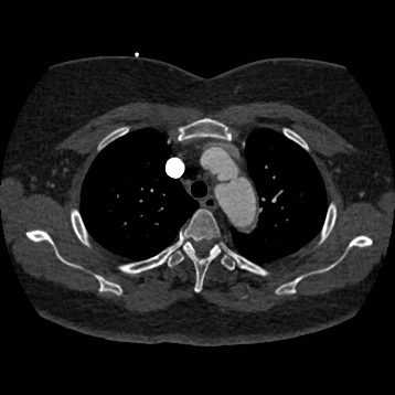 Aortic dissection (Radiopaedia 57969-64959 A 84).jpg