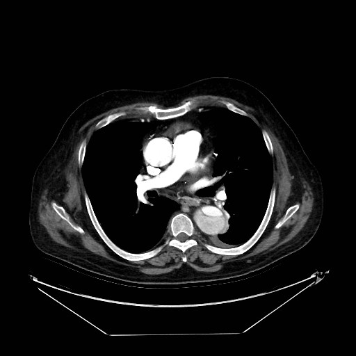 Aortic dissection (Radiopaedia 62562-71000 A 18).jpg