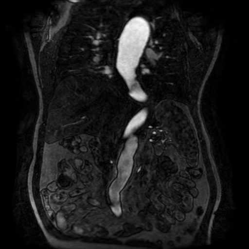 Aortic dissection - Stanford A - DeBakey I (Radiopaedia 23469-23551 D 130).jpg