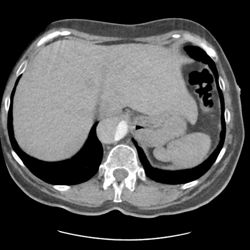 File:Aortic dissection - Stanford type B (Radiopaedia 50171-55512 A 44).png