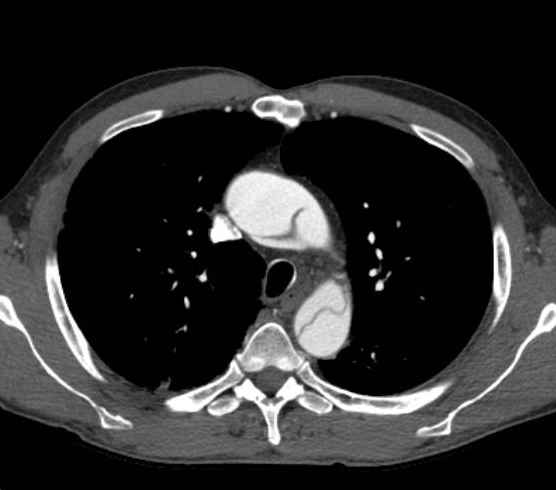 Aortic dissection - Stanford type B (Radiopaedia 73648-84437 A 28).jpg