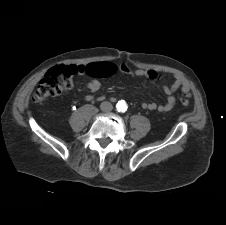 Aortic dissection with rupture into pericardium (Radiopaedia 12384-12647 A 71).jpg