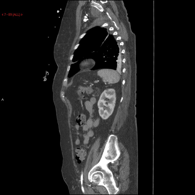 Aortic intramural hematoma (Radiopaedia 27746-28001 C 58).jpg