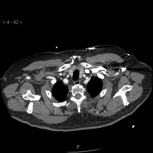 File:Aortic intramural hematoma (Radiopaedia 48463-53380 B 20).jpg