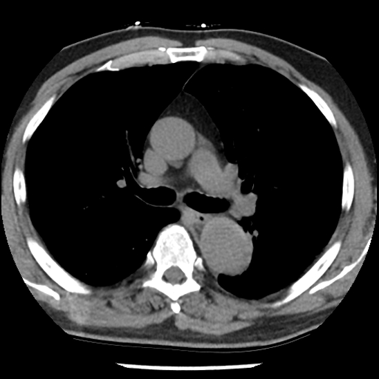 Aortic intramural hematoma (type B) (Radiopaedia 79323-92387 Axial non-contrast 21).jpg