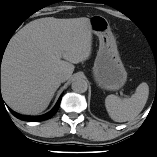 Aortic intramural hematoma (type B) (Radiopaedia 79323-92387 Axial non-contrast 51).jpg