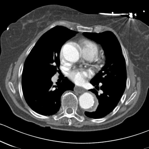 Aortic intramural hematoma from penetrating atherosclerotic ulcer (Radiopaedia 31137-31836 A 44).jpg