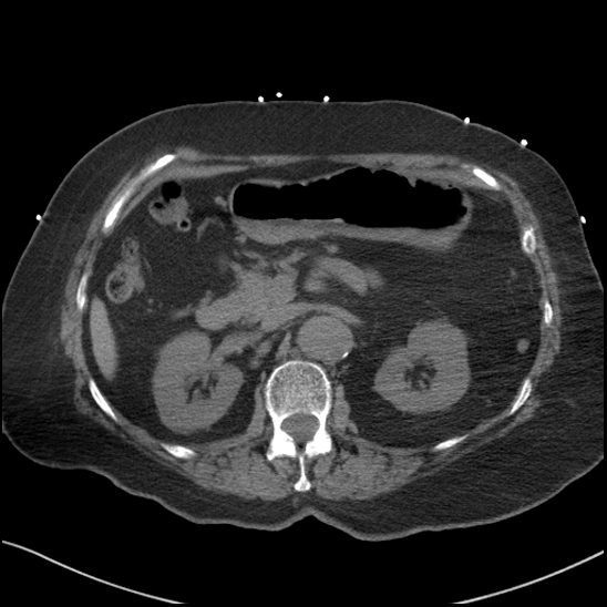 File:Aortic intramural hematoma with dissection and intramural blood pool (Radiopaedia 77373-89491 Axial non-contrast 109).jpg