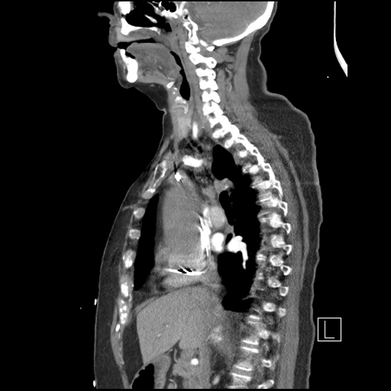 Aortic intramural hematoma with dissection and intramural blood pool (Radiopaedia 77373-89491 D 37).jpg