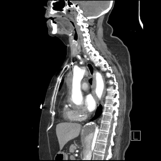 File:Aortic intramural hematoma with dissection and intramural blood pool (Radiopaedia 77373-89491 D 46).jpg