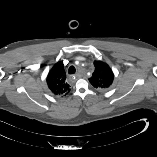 Aortic transection, diaphragmatic rupture and hemoperitoneum in a complex multitrauma patient (Radiopaedia 31701-32622 A 20).jpg