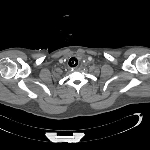 Aortic transection, diaphragmatic rupture and hemoperitoneum in a complex multitrauma patient (Radiopaedia 31701-32622 A 6).jpg