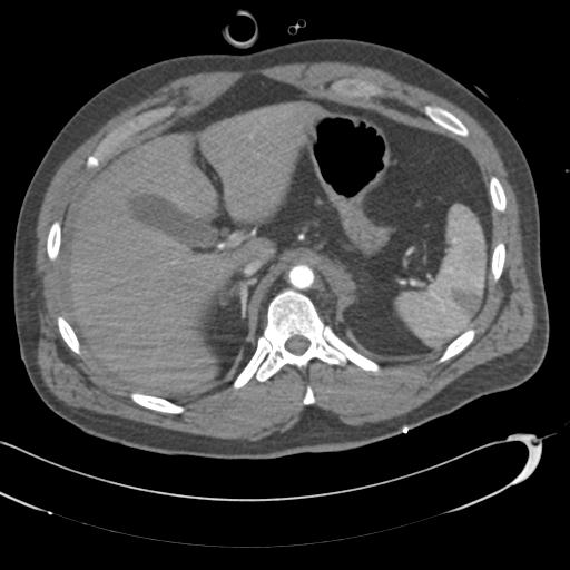 Aortic transection, diaphragmatic rupture and hemoperitoneum in a complex multitrauma patient (Radiopaedia 31701-32622 A 87).jpg