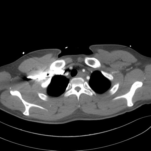 File:Aortic transection (Radiopaedia 29890-30405 A 18).jpg