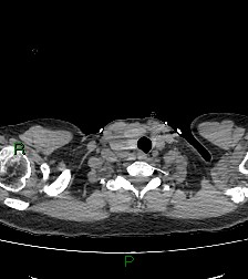 Aortic valve endocarditis (Radiopaedia 87209-103485 Axial non-contrast 7).jpg