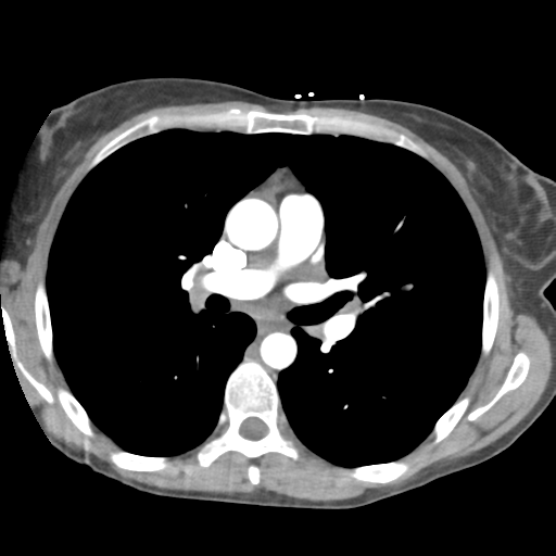 File:Aortic valve non-coronary cusp thrombus (Radiopaedia 55661-62189 B 23).png