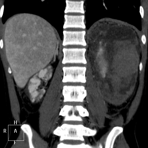 File:Aorto-left renal vein fistula (Radiopaedia 45534-49628 B 52).jpg