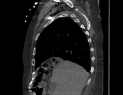 Aortoesophageal fistula with endovascular repair (Radiopaedia 73781-84592 Sagittal C+ CTPA 41).jpg