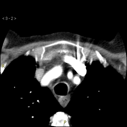 File:Aortoiliac occlusive disease (Radiopaedia 16828-16548 A 2).jpg