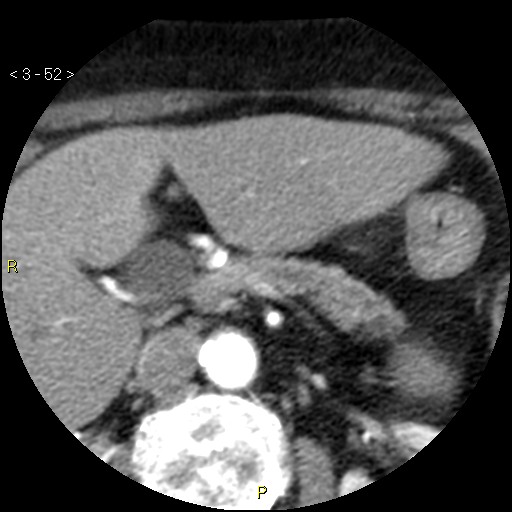 Aortoiliac occlusive disease (Radiopaedia 16828-16548 A 52).jpg