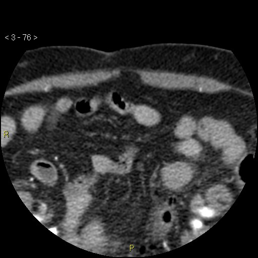 Aortoiliac occlusive disease (Radiopaedia 16828-16548 A 76).jpg