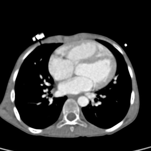 File:Aortopulmonary window, interrupted aortic arch and large PDA giving the descending aorta (Radiopaedia 35573-37074 B 53).jpg