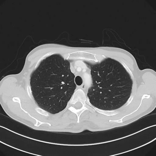 Apical pleural calcification (Radiopaedia 46141-50499 Axial lung window 18).png