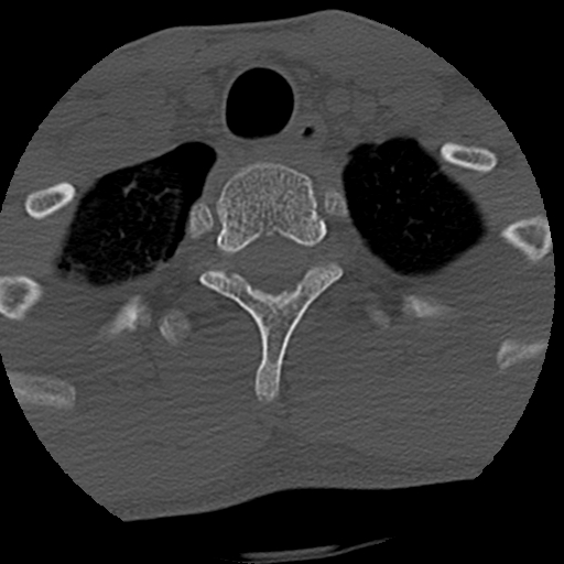 Apical pneumothorax on cervical spine CT (Radiopaedia 45343-49368 Axial bone window 88).jpg