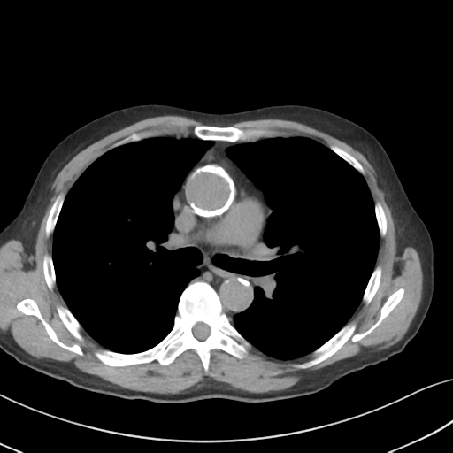 Apical pulmonary metastasis (Radiopaedia 46338-50754 B 29).png
